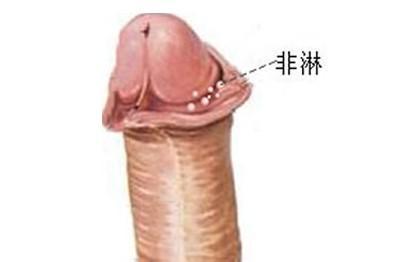 男性尿道口红肿,非淋是幕后黑手